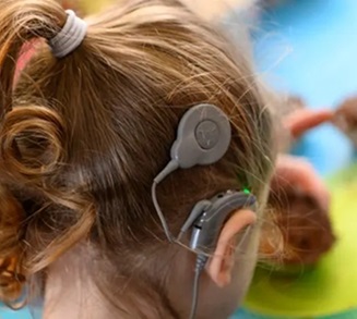 Cochlear Implant