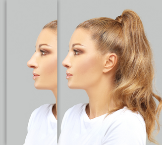 Rhinoplasty